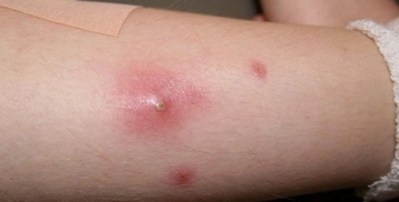 Aslan Pençesi Hastalığı Belirtileri ve Tedavisi